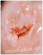 hpv