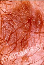 HPV - VIN