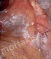 HPV - VIN