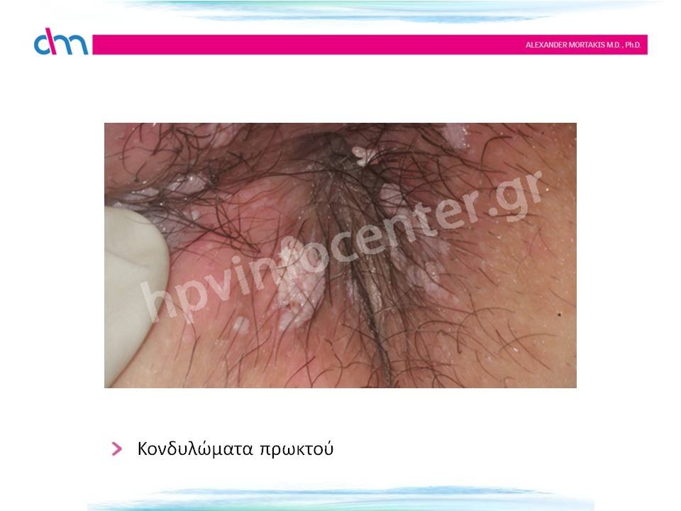 anal warts - κονδυλώματα πρωκτού