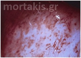 colposcopy