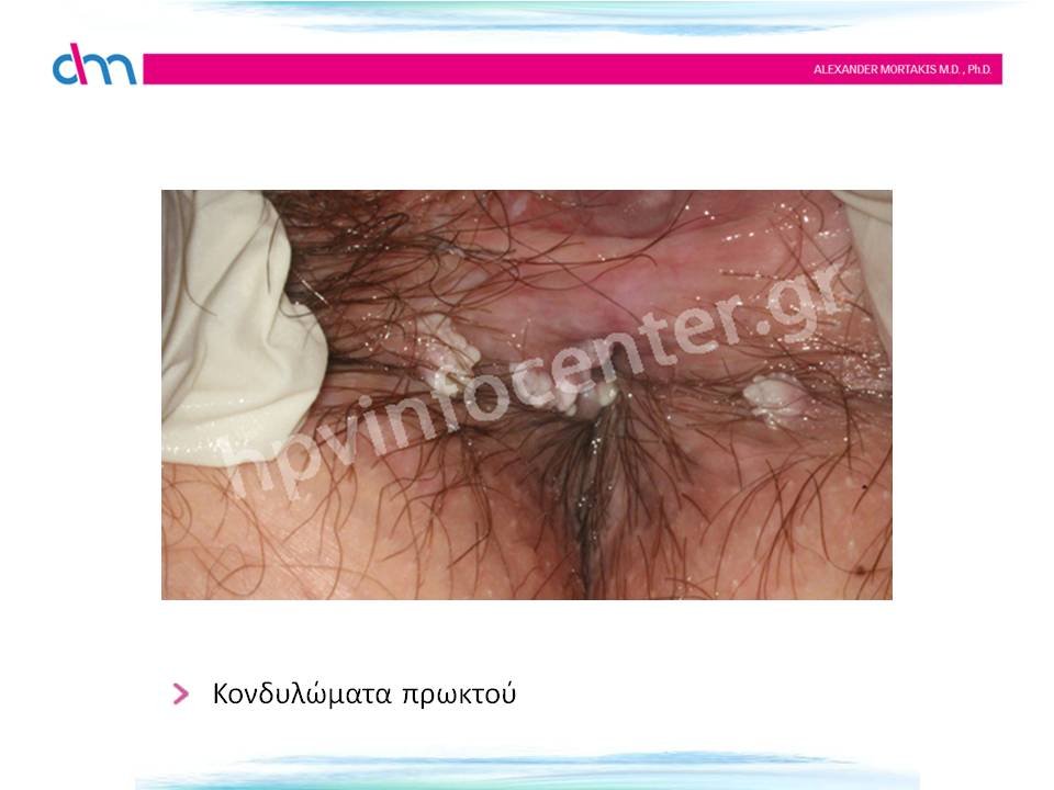 anal warts - κονδυλώματα πρωκτού