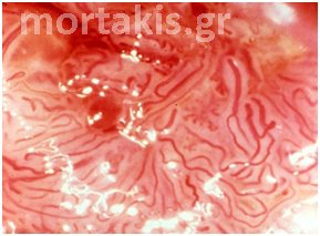 colposcopy