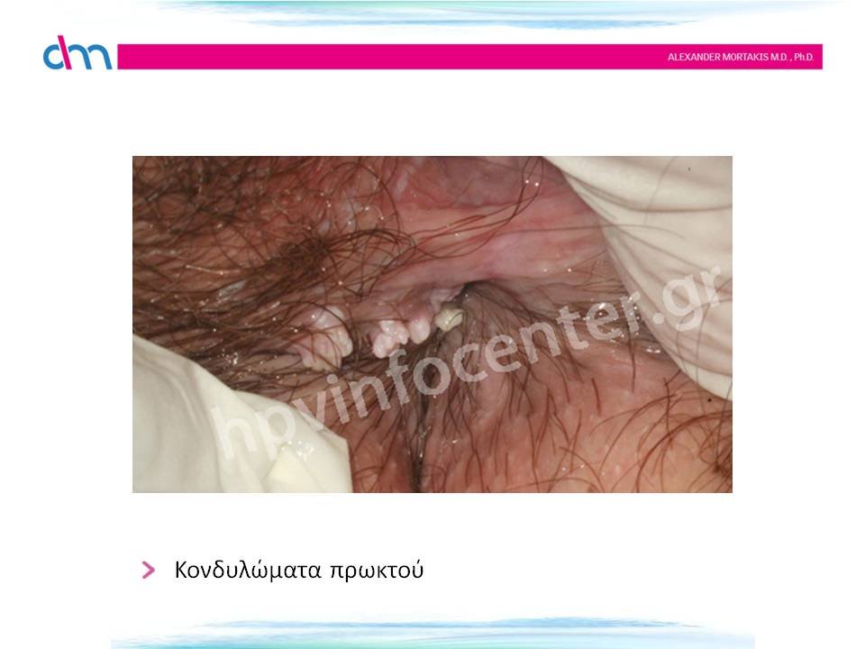 anal warts - κονδυλώματα πρωκτού