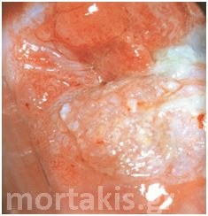cervical cancer