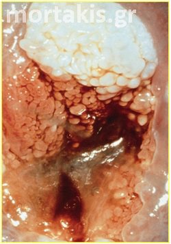colposcopy
