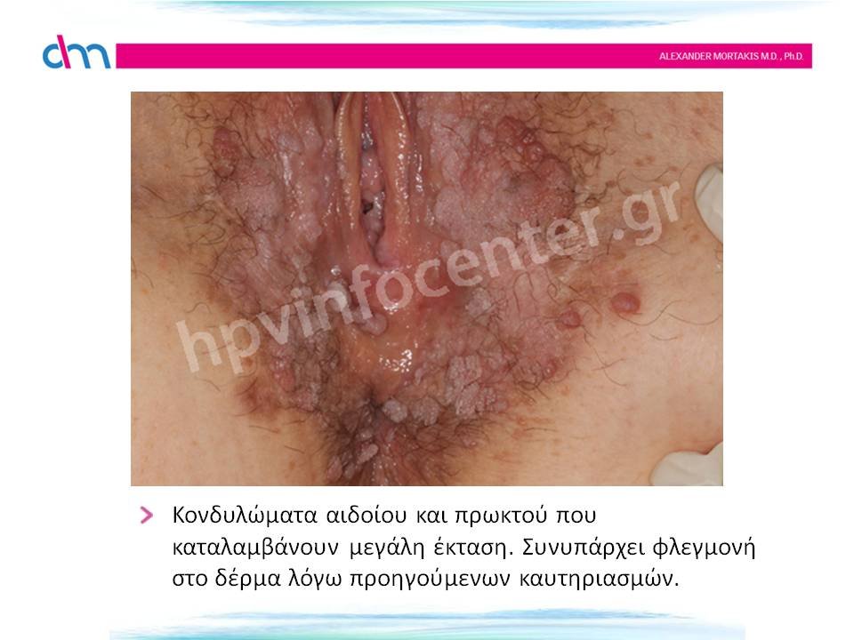 warts - κονδυλώματα αιδοίου και πρωκτού