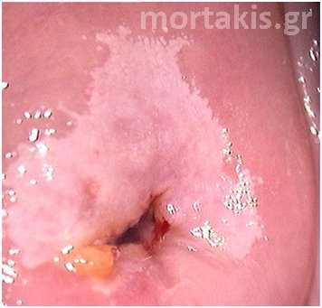HPV - LSIL