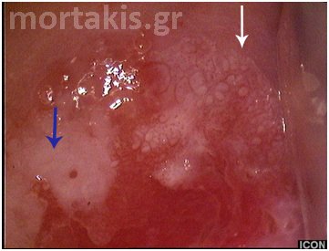 HPV - LSIL