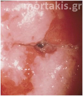 HPV - HSIL