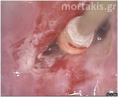 HPV - HSIL
