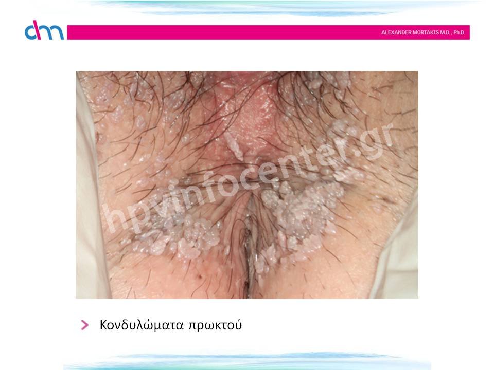 Κονδυλώματα πρωκτού
