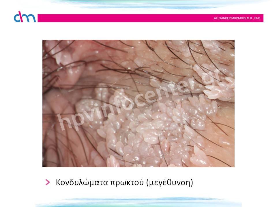 Κονδυλώματα πρωκτού