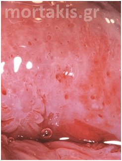 colposcopy