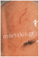 colposcopy