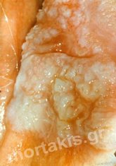 HPV - VIN