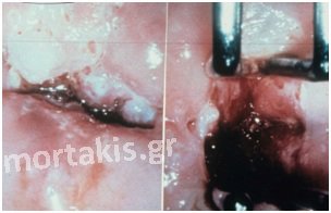 colposcopy