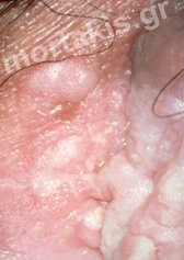 HPV - VIN