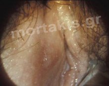HPV - VIN