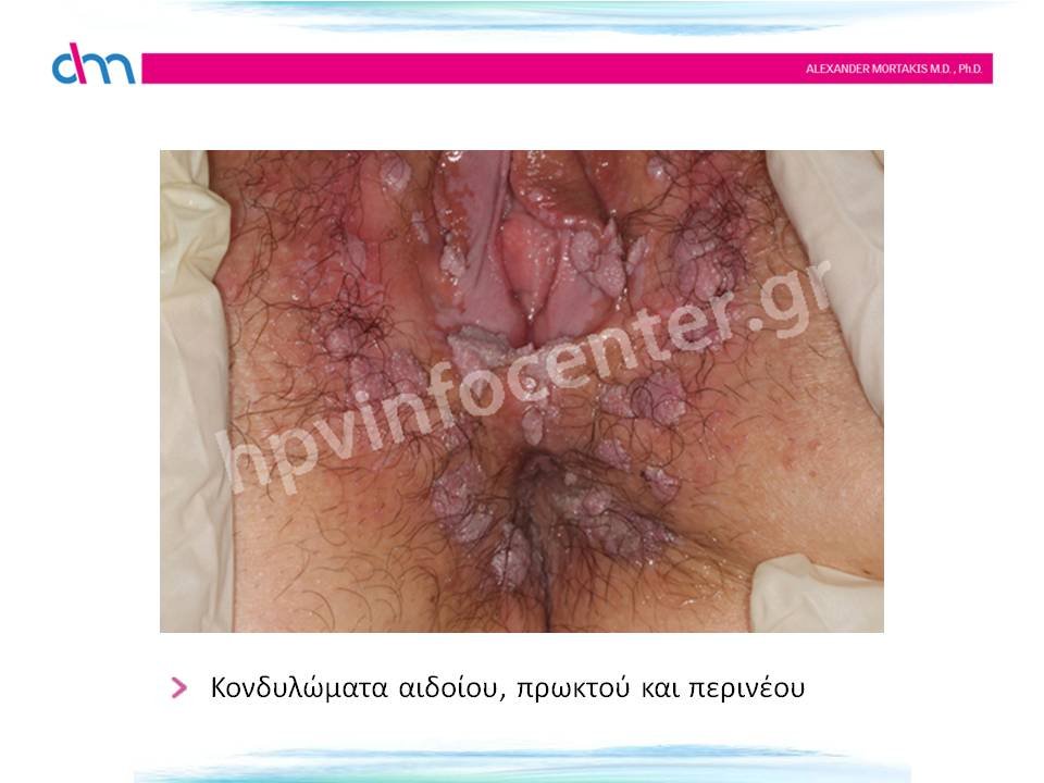 Κονδυλώματα αιδοίου, πρωκτού και περινέου