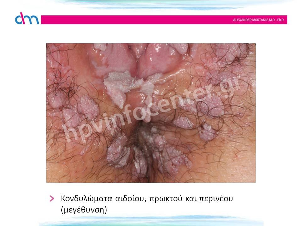 Κονδυλώματα αιδοίου, πρωκτού και περινέου