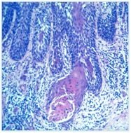 HPV - VIN