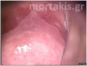 colposcopy