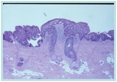 HPV - VIN
