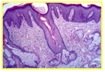 HPV - VIN