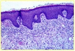 HPV - VIN