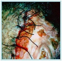 HPV - VIN