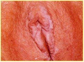 HPV - VIN