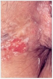 HPV - VIN