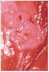 HPV - VIN