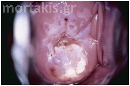 HPV