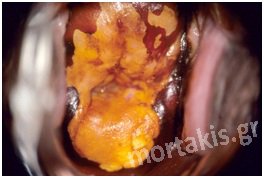 HPV