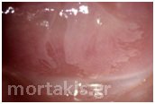 hpv hpv