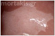 hpv hpv