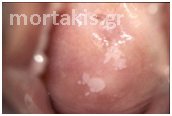 warts warts