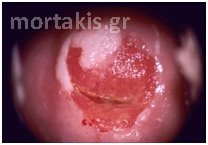 genital warts