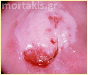 colposcopy