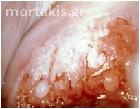 HPV - HSIL