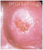 HPV - LSIL
