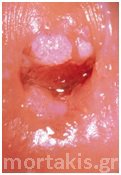 HPV _LSIL