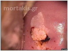 HPV - LSIL