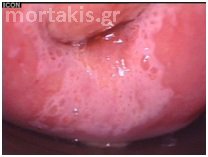 HPV - LSIL