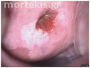 HPV - HSIL
