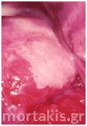 HPV - HSIL