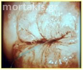 HPV - HSIL