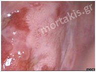 HPV - HSIL